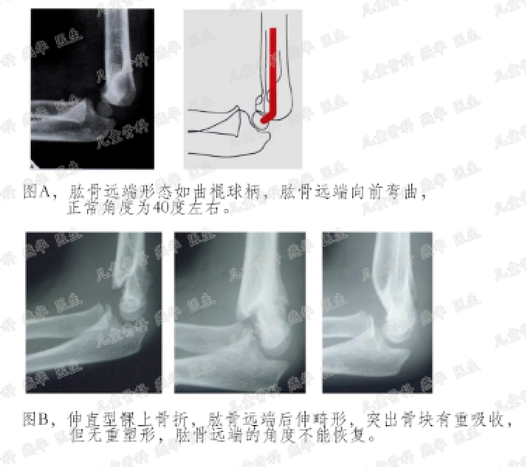 肘内翻畸形的预防和治疗