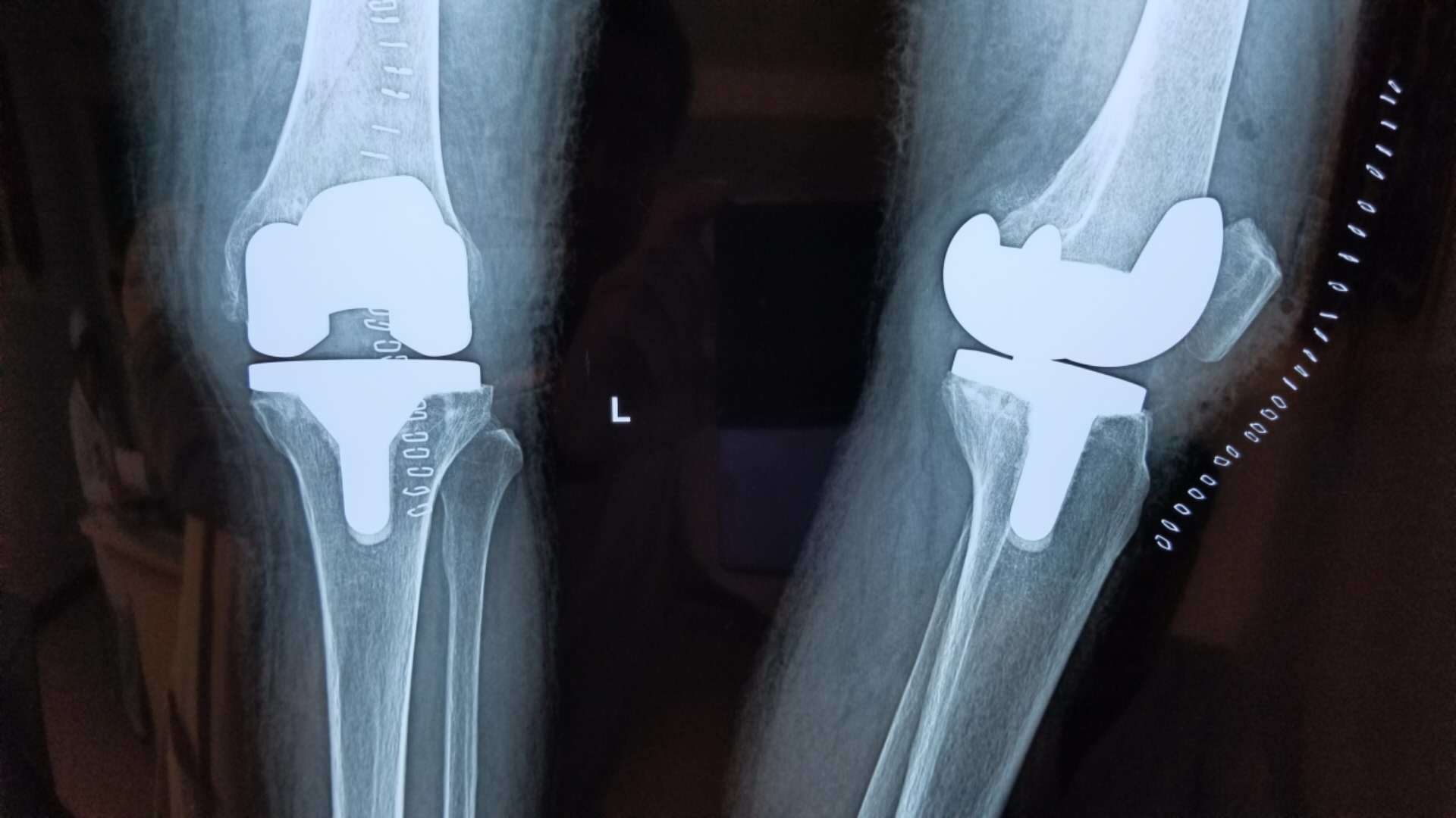 哪些情况适宜做膝关节置换手术?