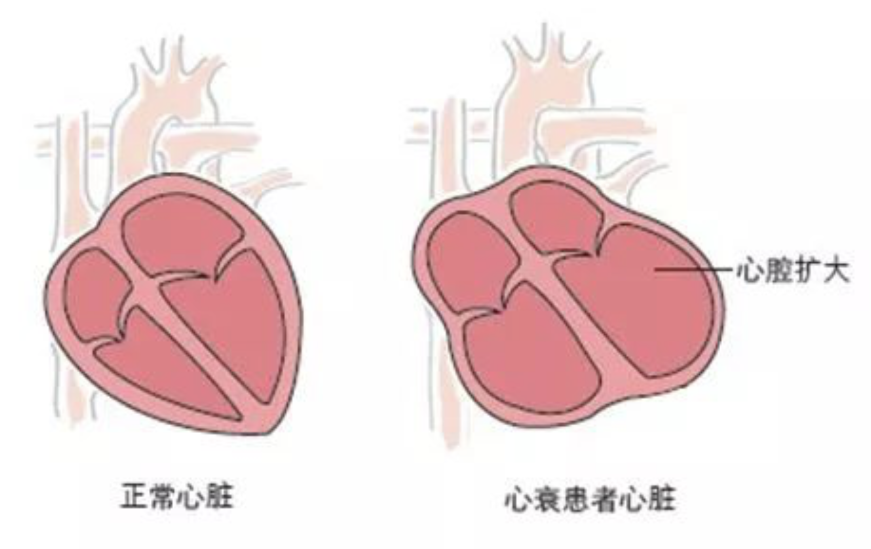 (图2心衰心腔扩大示意图)三,心衰如何导致房颤?