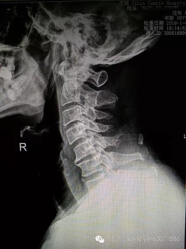 (图示:颈椎退变,颈椎椎体前,后缘增生,c5,6椎间隙变窄,项韧带骨化,c6