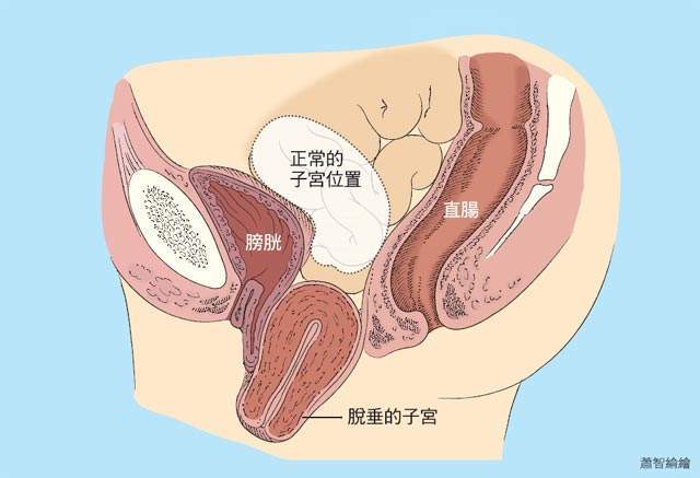 李咏 文章列表  在门诊,我们经常会遇到一些老年女性,主诉发现一个"