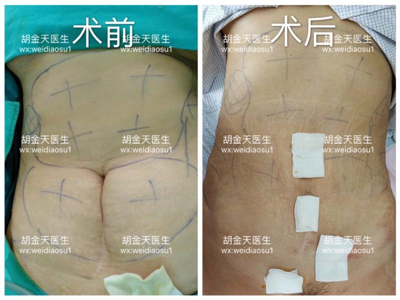 腹部吸脂案例1