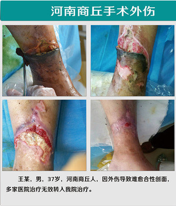 手术后伤口红肿化脓,该怎么办?