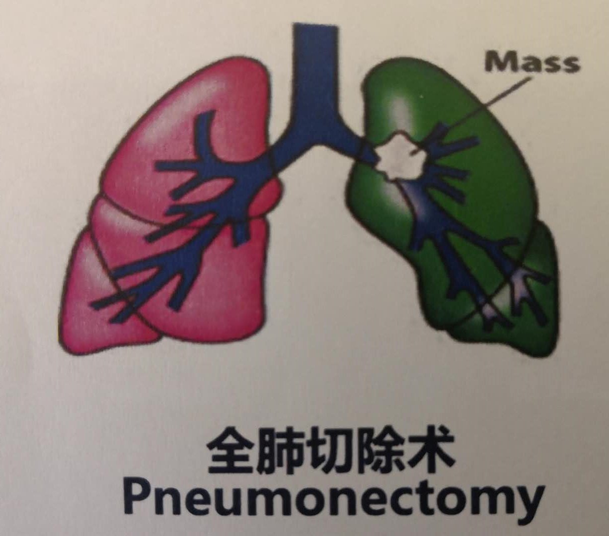 保留健康肺组织肺叶切除术