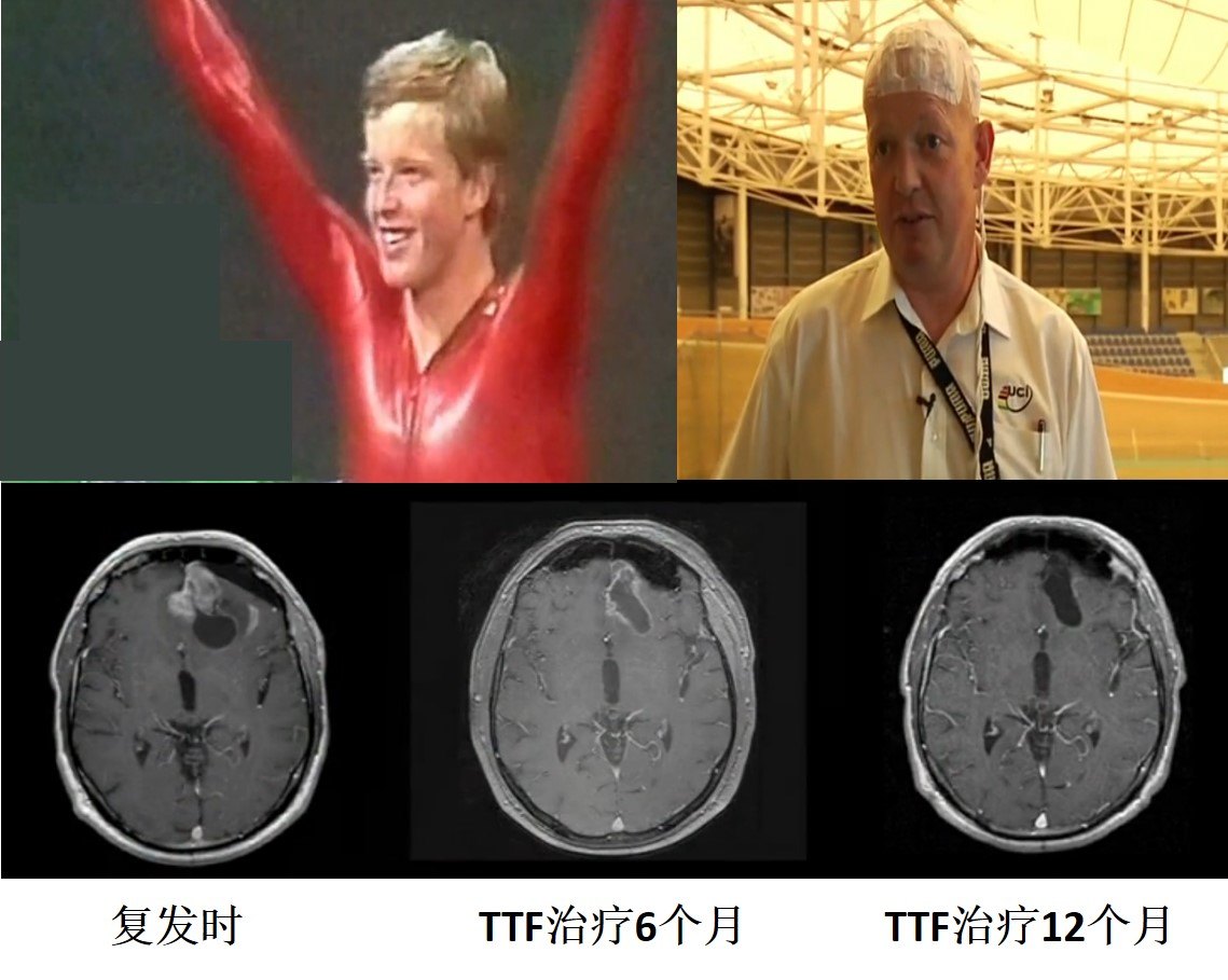 电场治疗胶质瘤最前沿的治疗方法