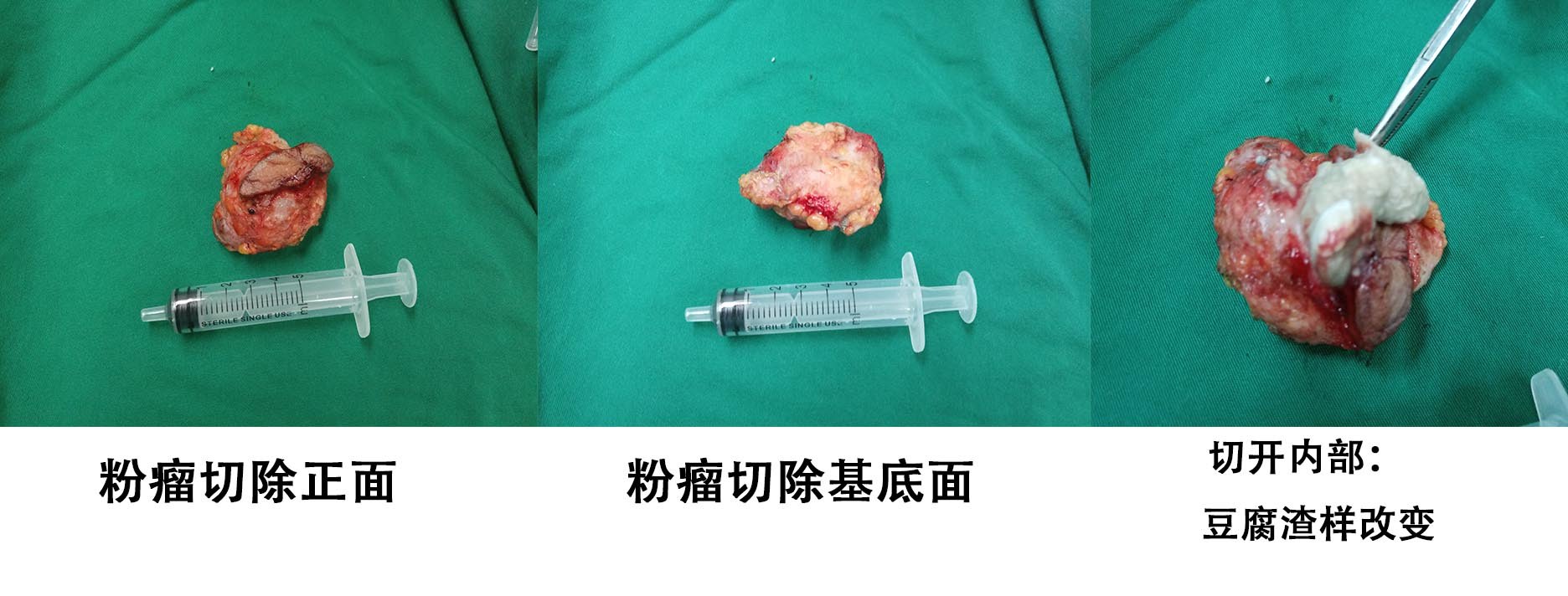 皮脂腺囊肿(粉瘤)、脂肪瘤、淋巴结的鉴别及正