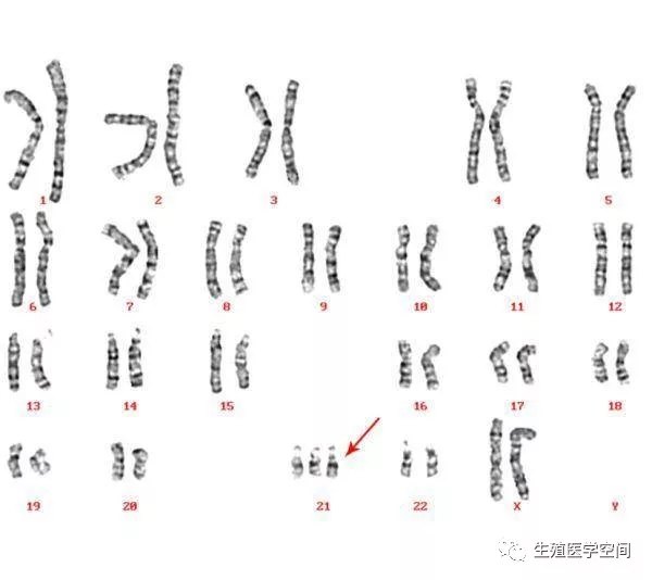21三体的染色体核型
