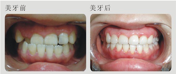牙齿矫正能只矫正一排牙齿吗?