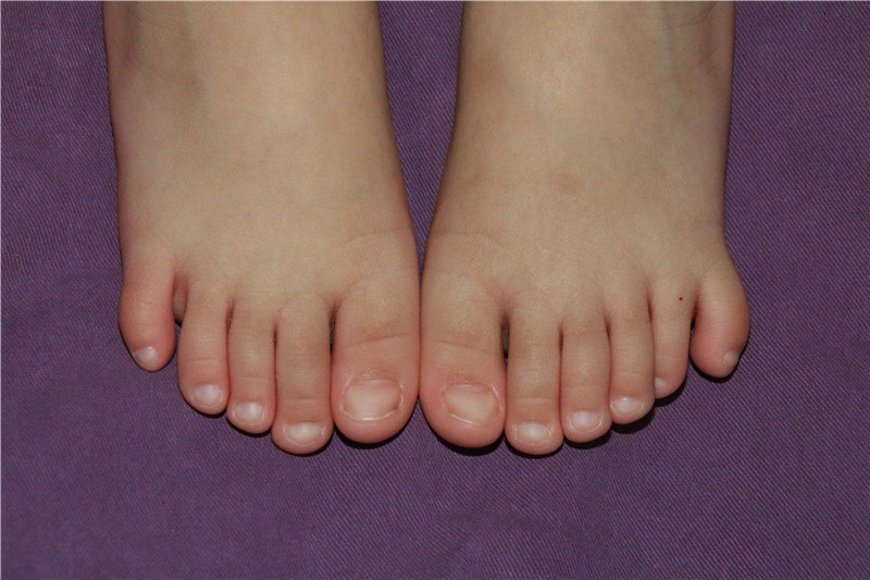 六趾畸形六个脚趾头迷信说法六趾畸形是什么原