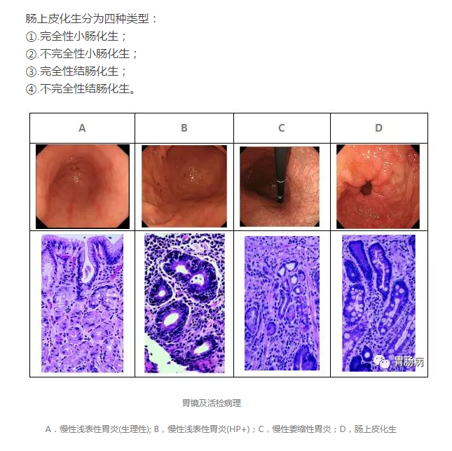 "肠化"究竟是一种什么"病"?