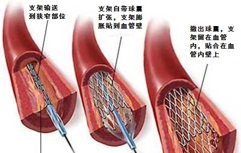 心脏支架会掉下来吗
