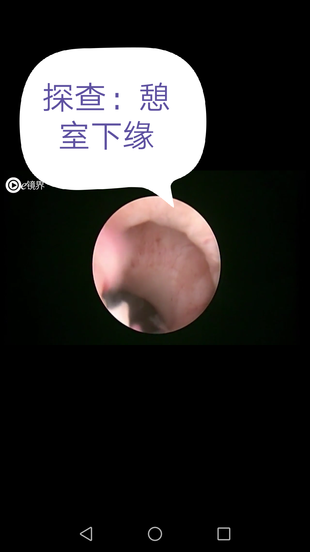 手术解析:宫腔镜下切除-剖宫产术后子宫切口憩