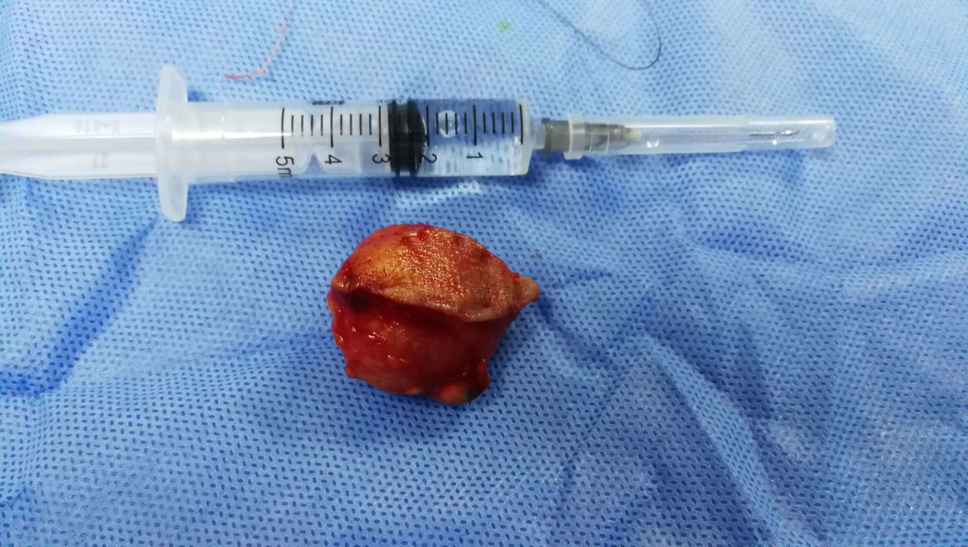 皮脂腺囊肿(粉瘤)需要手术吗?