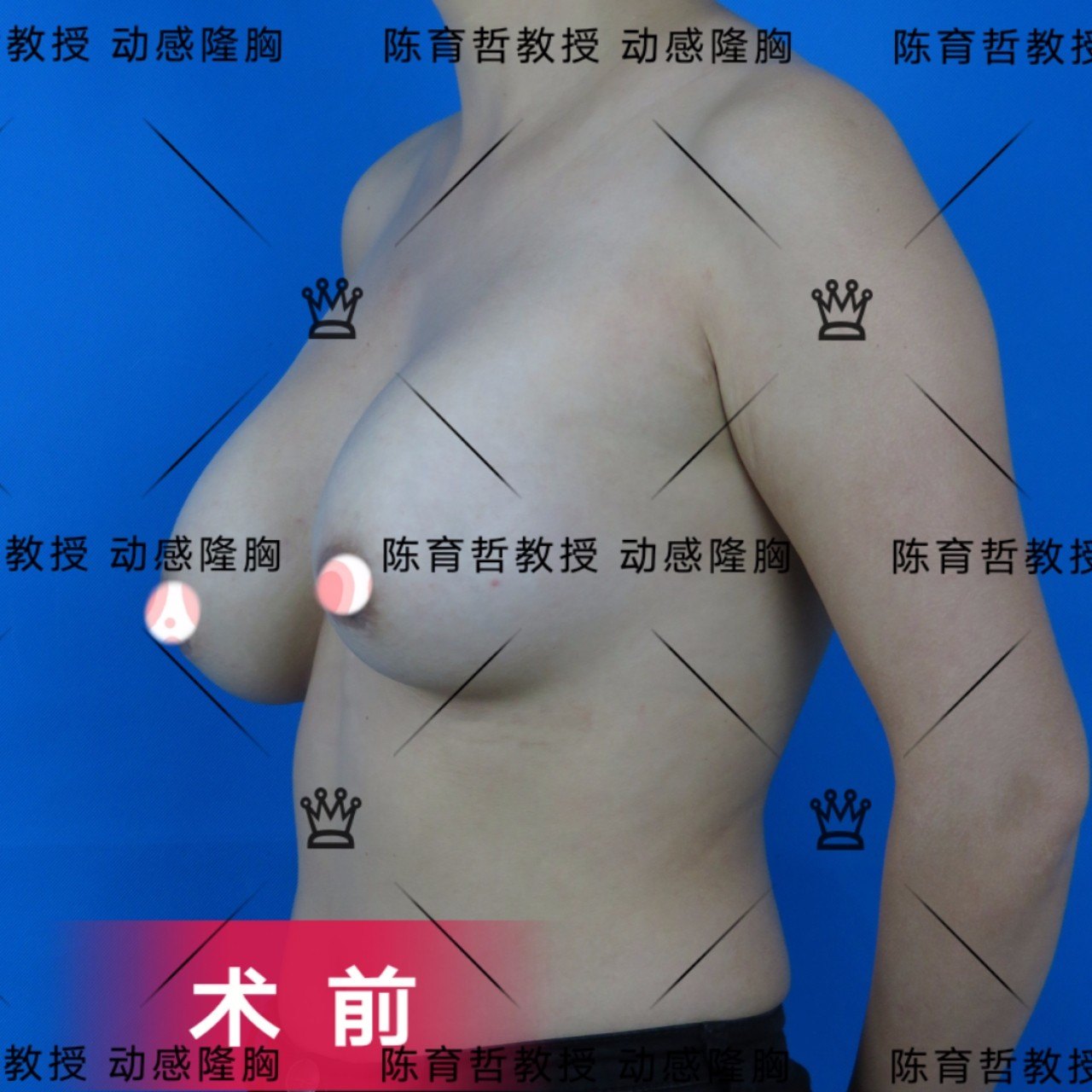 动感隆胸案例(36)注射物取出再植入假体的包膜