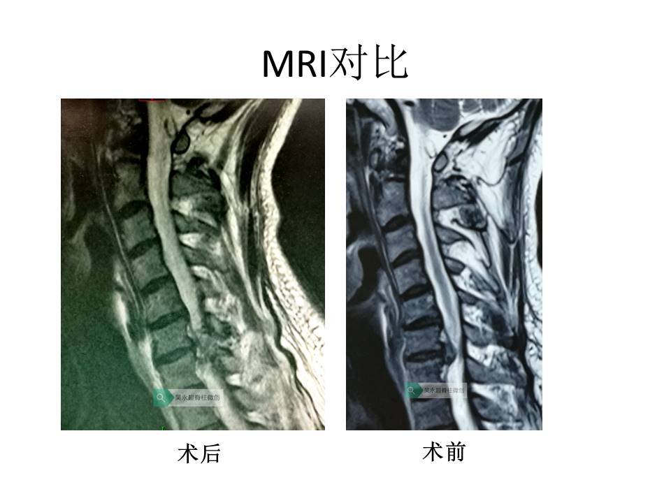 什么是颈椎病(神经根型)的最微创手术治疗方法