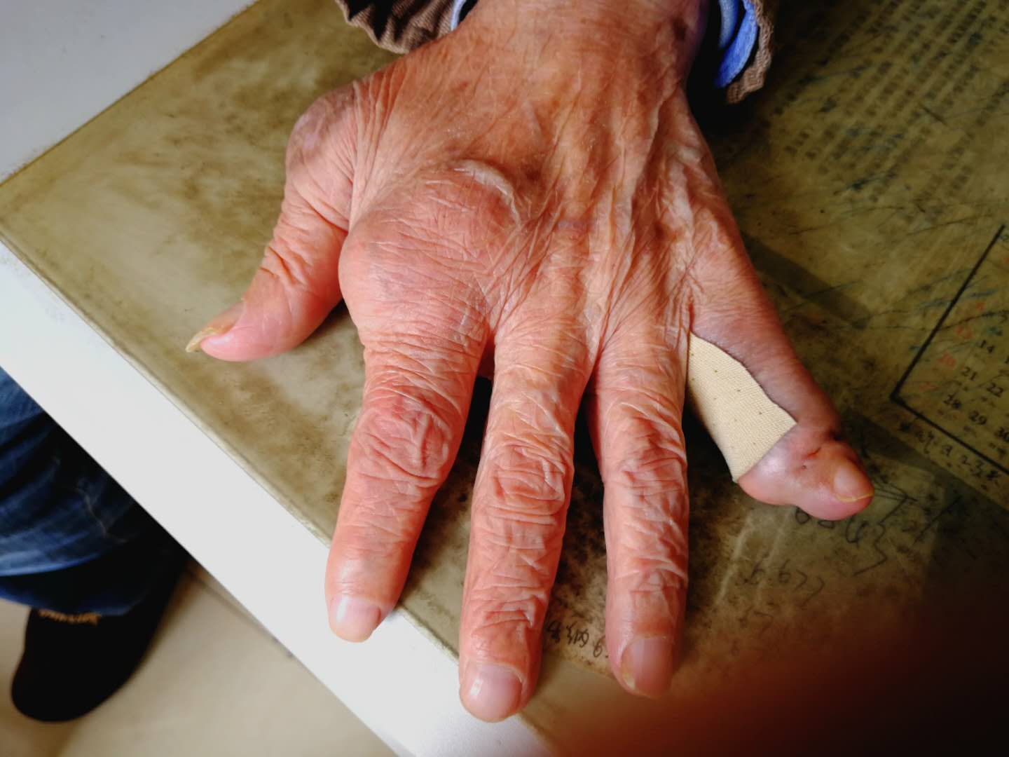 严重痛风患者病例分享:事实胜于雄辩,治疗看疗