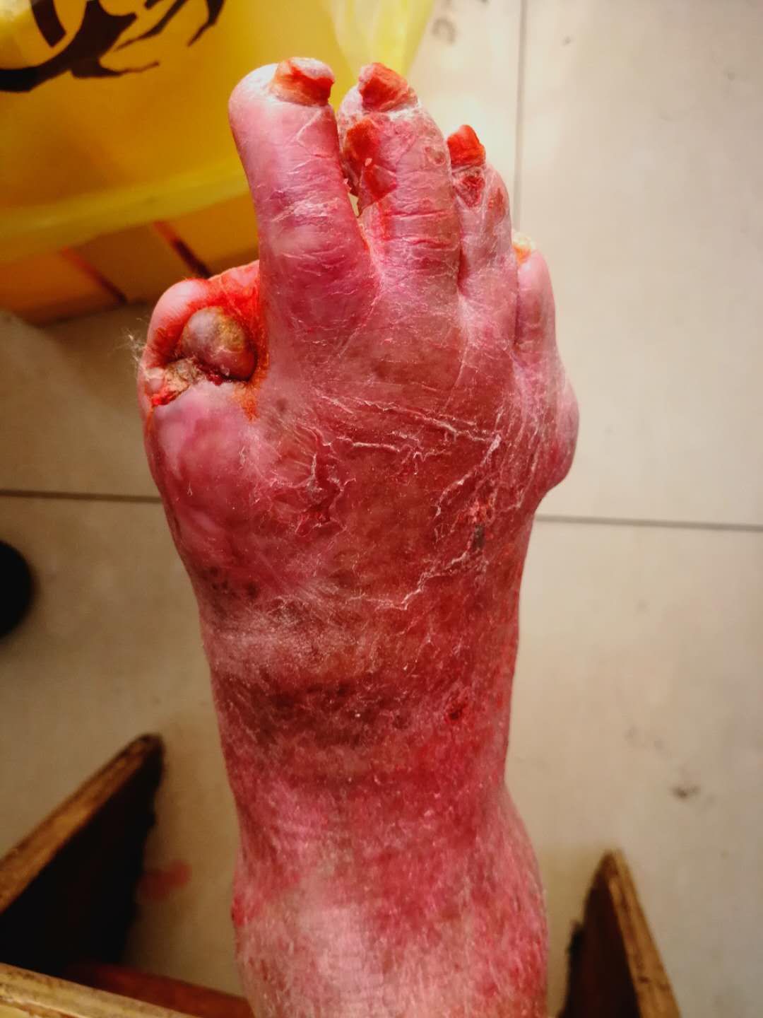 严重痛风患者病例分享:事实胜于雄辩,治疗看疗