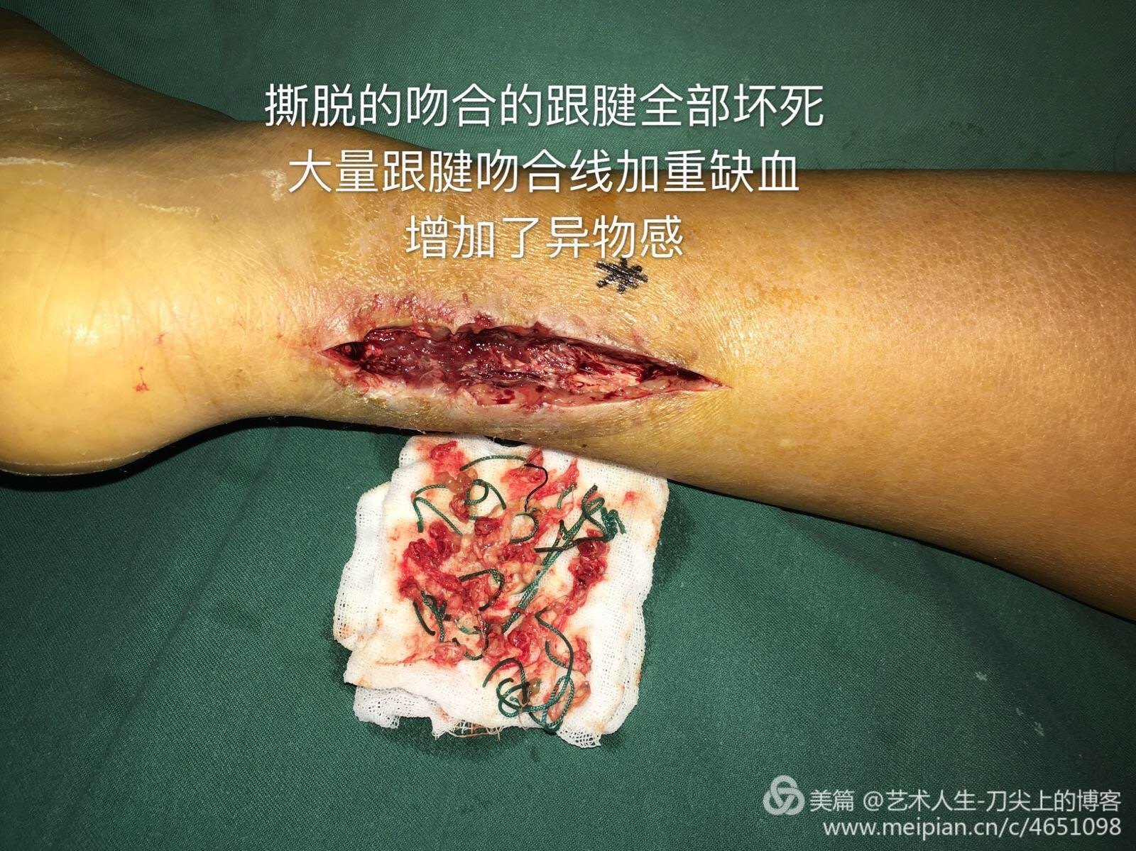 跟腱撕裂术后局部坏死,大量跟腱缝合线跟腱撕裂术后局部坏死,溃疡