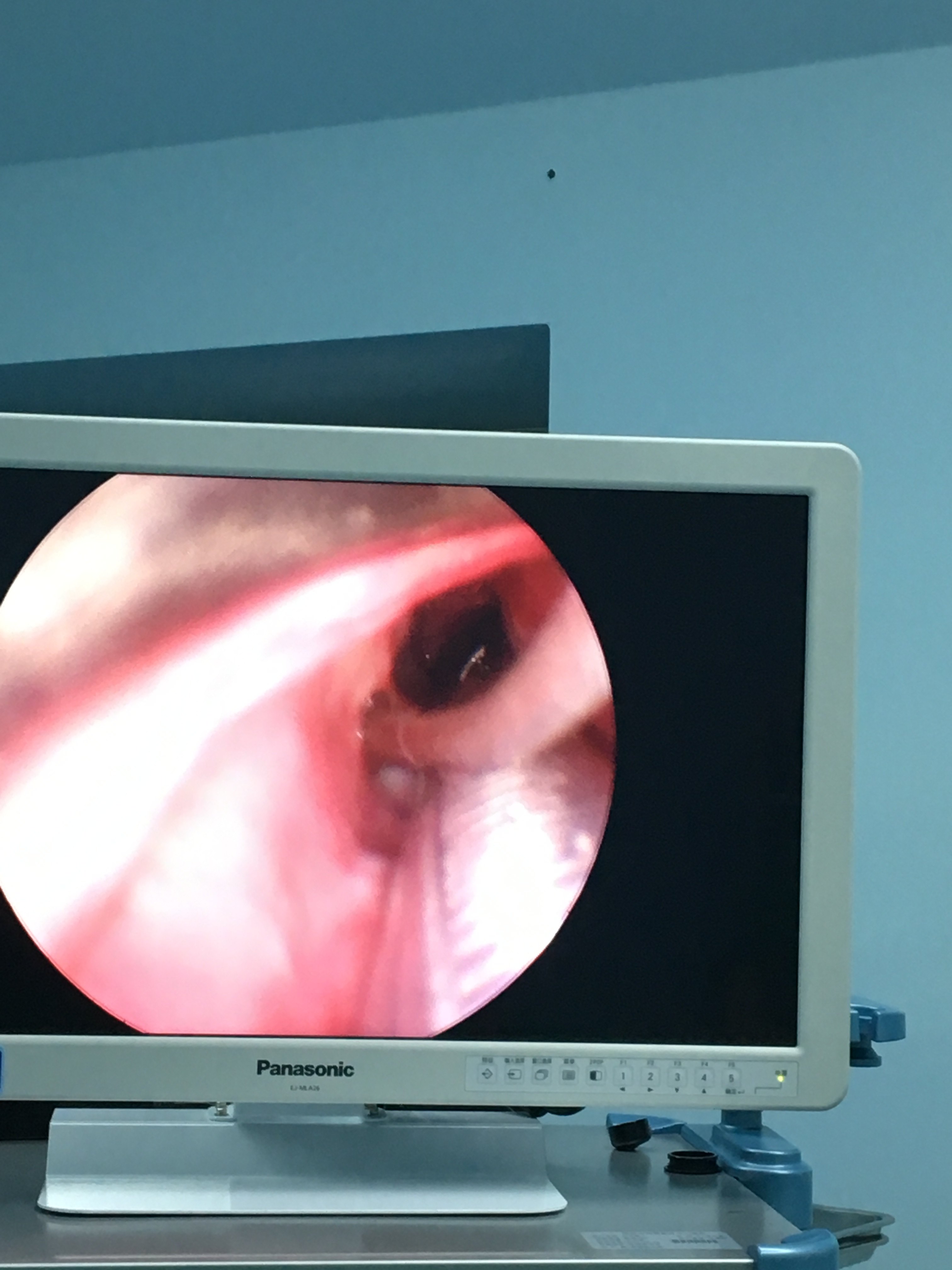 一例全麻下支撑喉镜声带暴露困难的声带息肉手术的分享