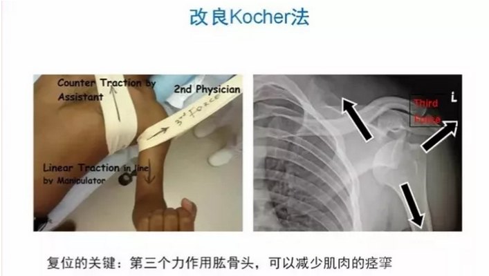 关节脱位肩关节前脱位的多种手法复位方法