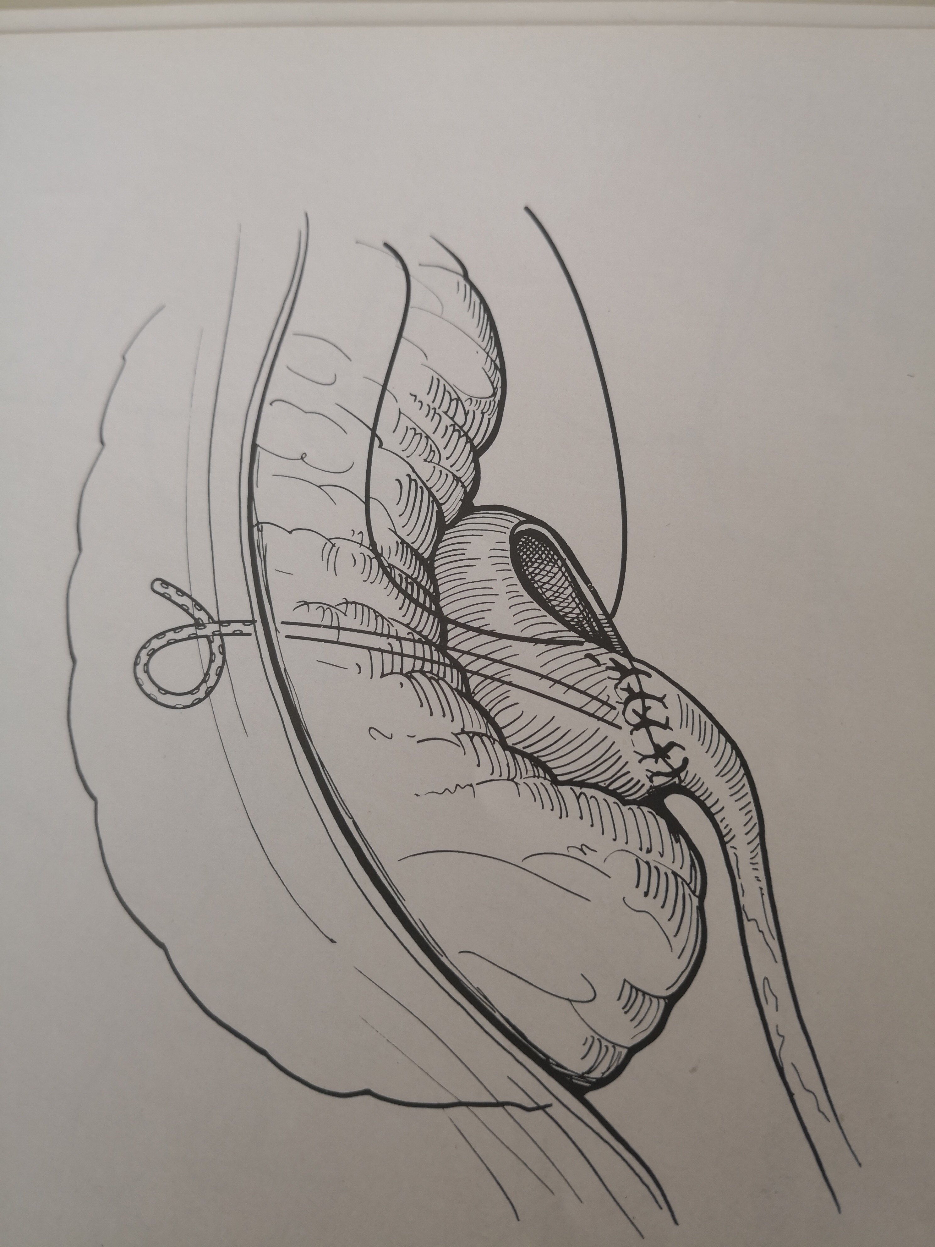肾积水-肾盂输尿管连接部狭窄