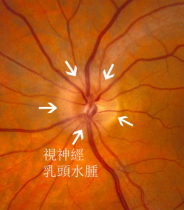 视神经发炎的诊断与最新治疗