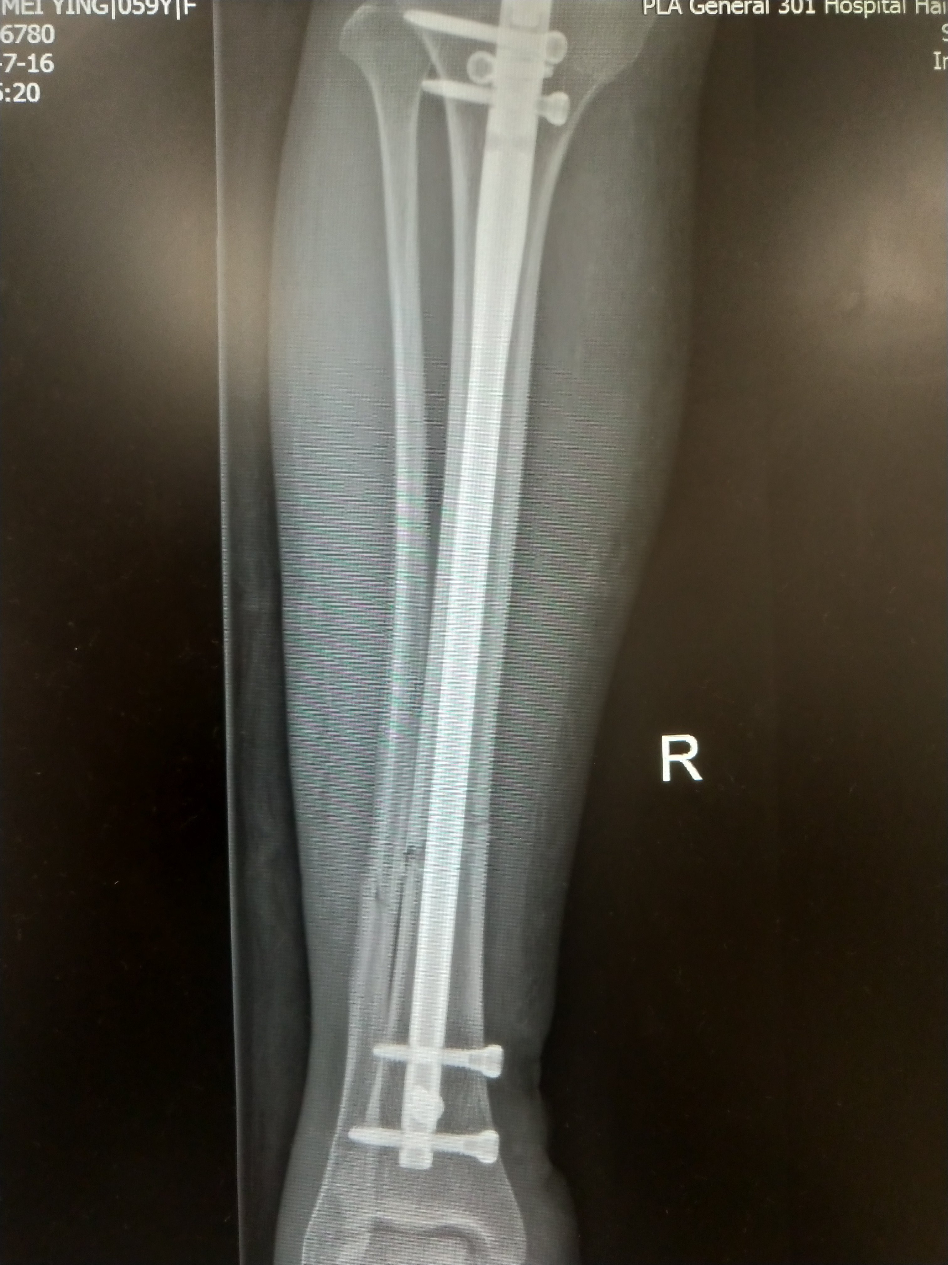 小腿胫腓骨骨折,微创髓内钉固定,第二天下地负重