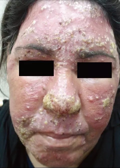 sdrr 的年轻女性在停用 tcs 后的反跳现象,表现为泛发性丘脓疱疹
