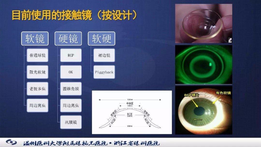 接触镜的验配管理及应用的经验