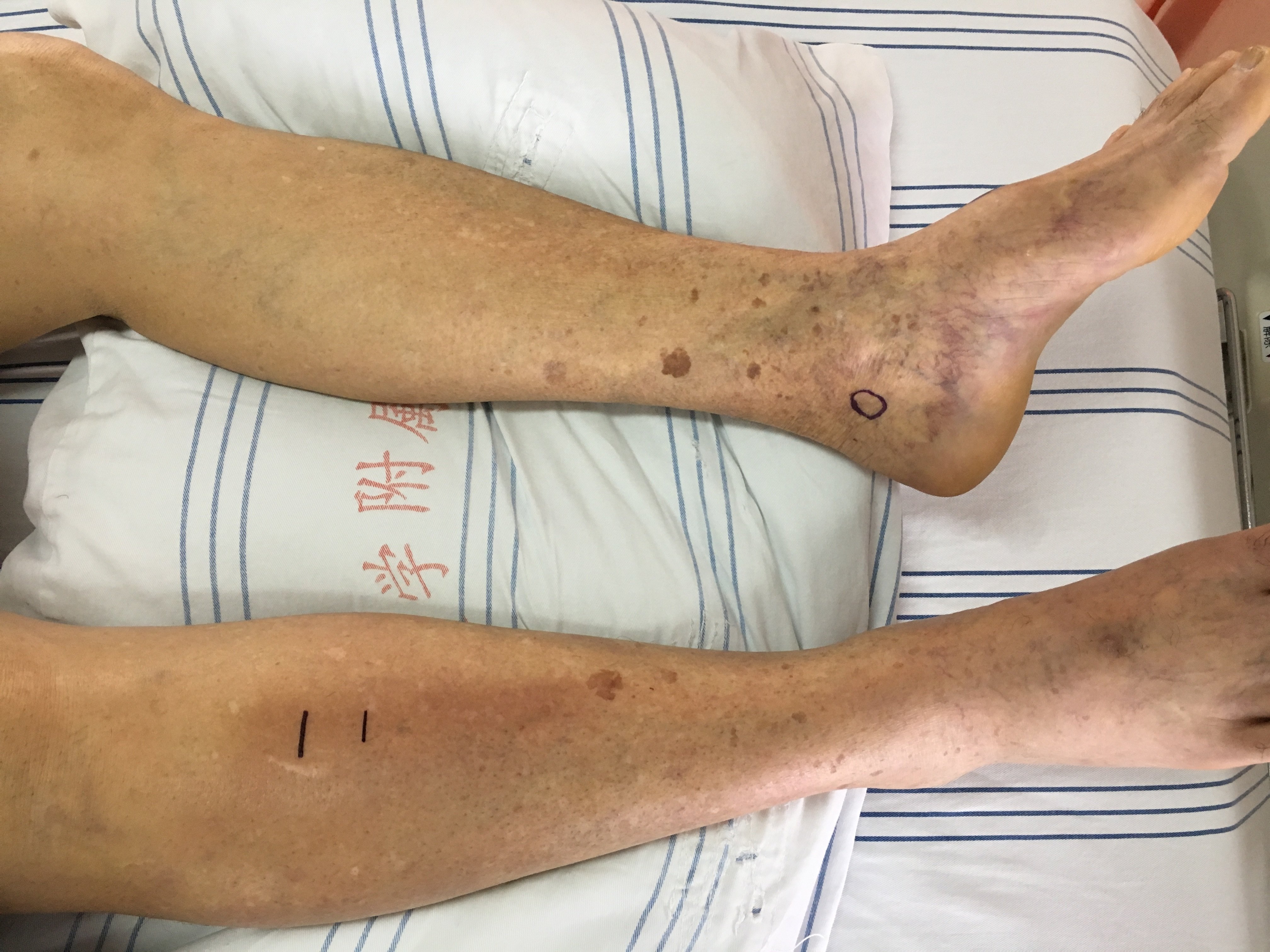 要重视急性下肢缺血病因的甄别