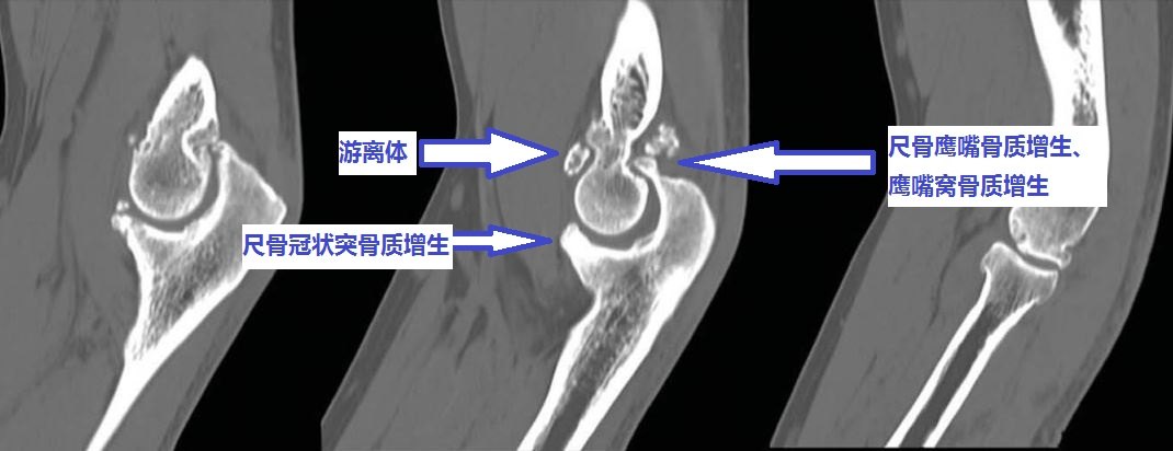 是因为:1,尺骨鹰嘴骨质增生;2,肱骨远端后侧的尺骨鹰嘴窝骨质增生填塞