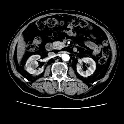 腹腔镜肾切除\/部分切除术(肿瘤性、无功能肾、