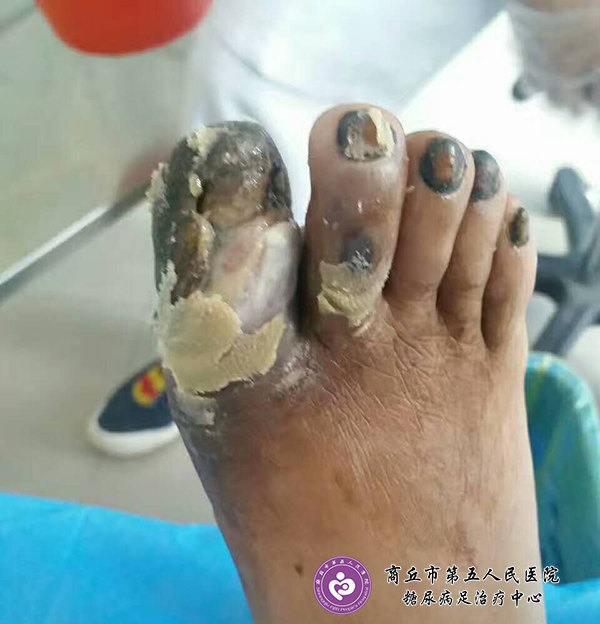 脚趾发黑坏疽要怎么治才能彻底根治?