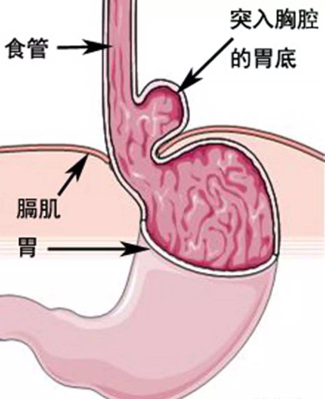 当食管裂孔疝遇上胃食管反流微创手术效果佳