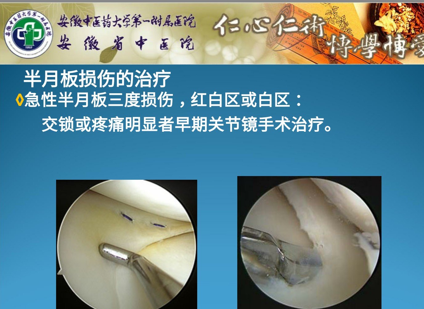 图解半月板损伤的原因及诊治策略