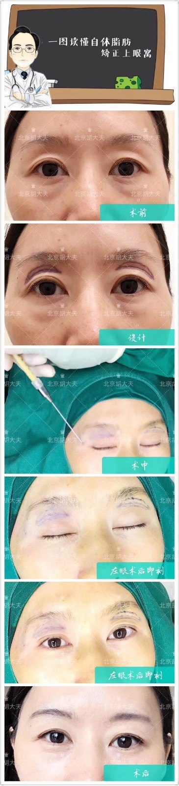 眼窝凹陷显老怎么治疗