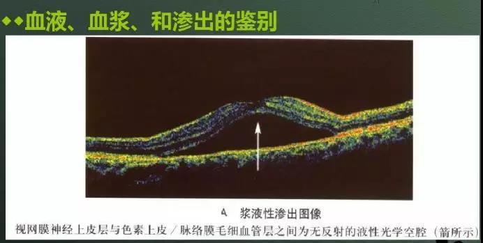 眼科新手必读:oct结果解读