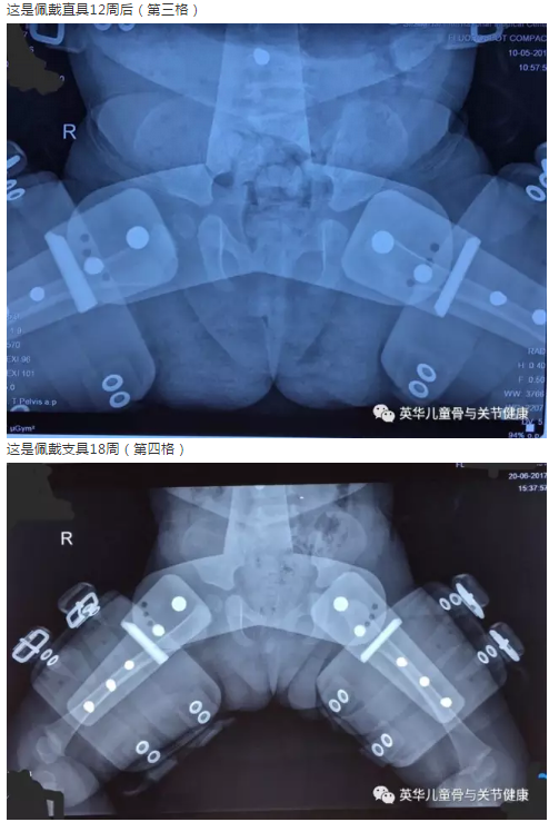 髋关节脱位手法复位石膏固定术后护理与案例展示