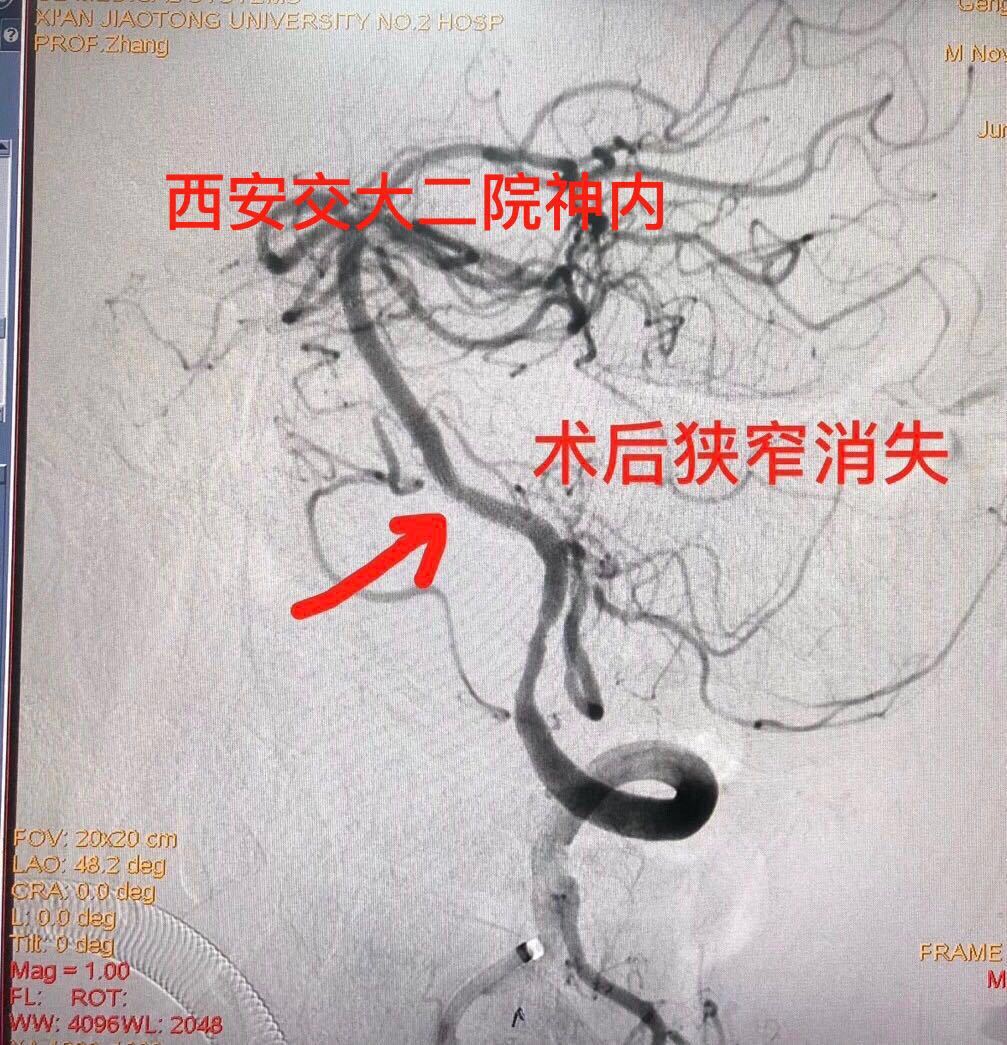 基底动脉狭窄支架术