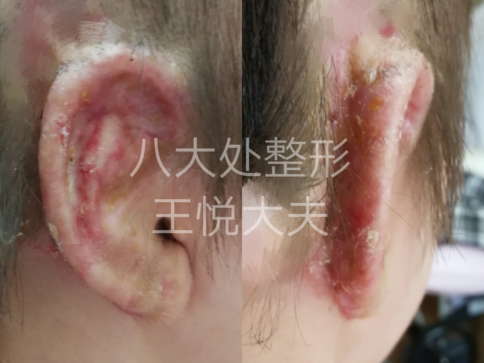 人工材料一次成形术后恢复期