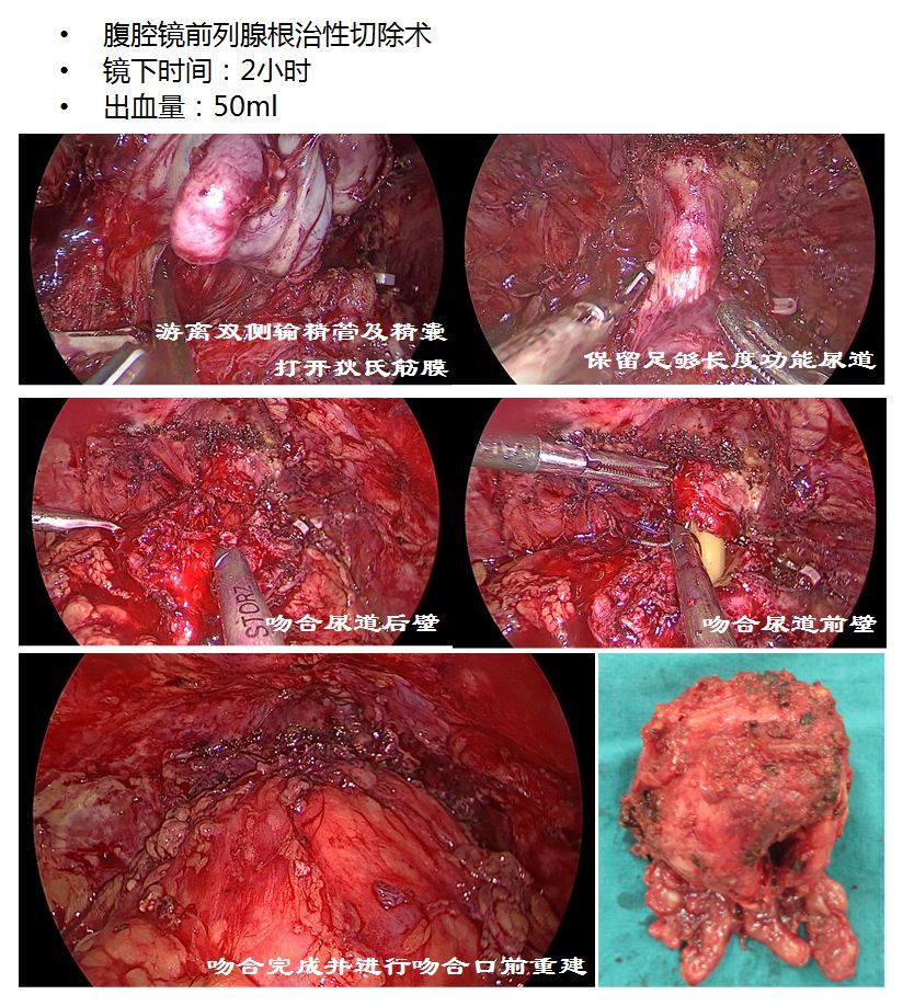 腹腔镜前列腺癌根治术