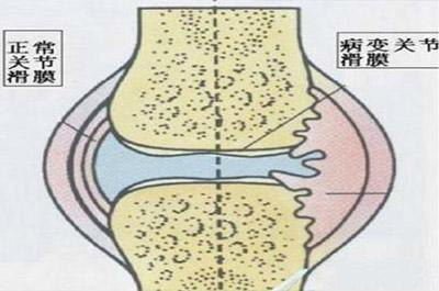 滑膜炎能被彻底根治吗