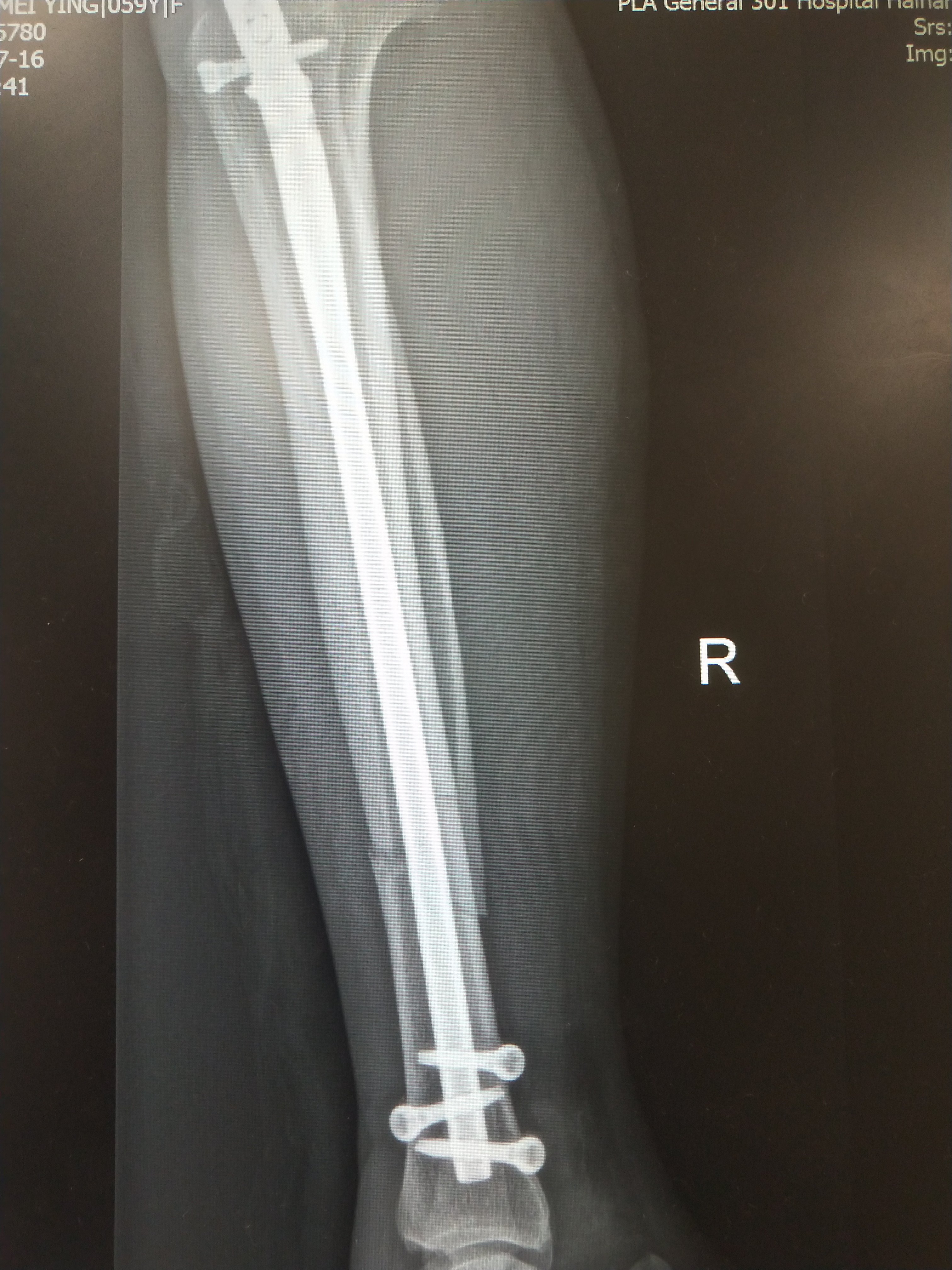 小腿胫腓骨骨折,微创髓内钉固定,第二天下地负重