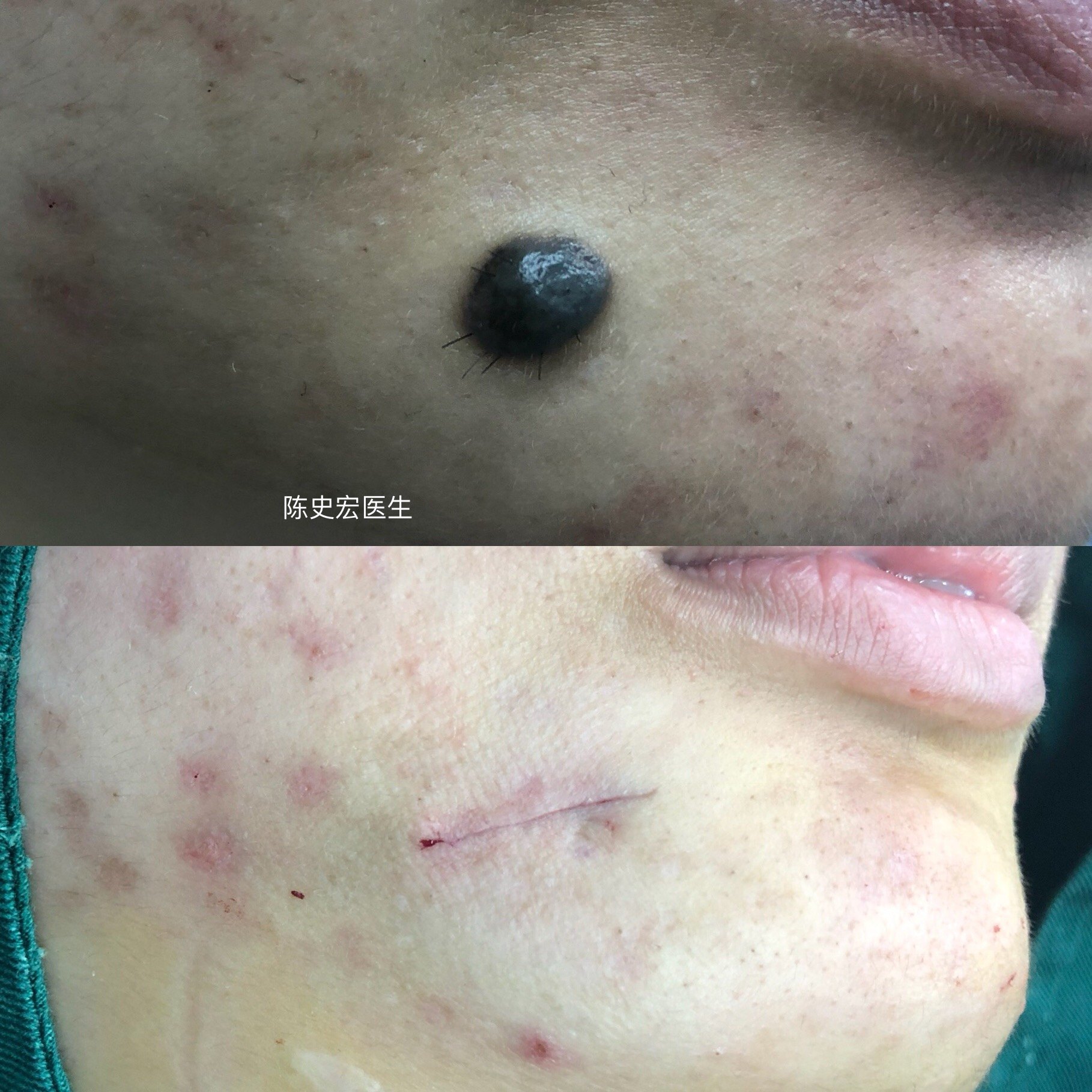 色素痣切除 精细缝合
