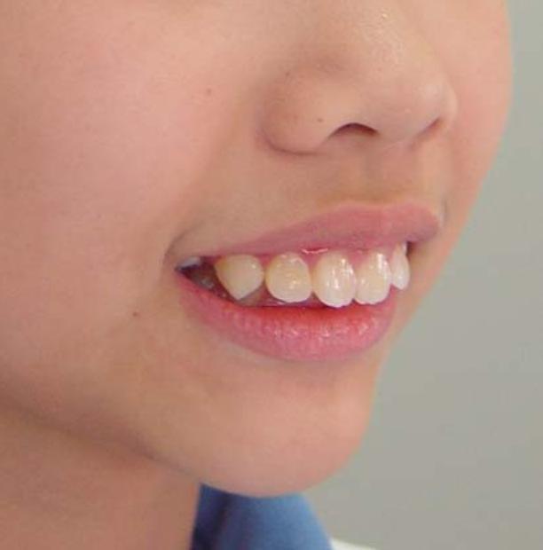 习惯之一,多发生在6~15岁之间,女孩的发生率高于男孩,以咬下唇多见