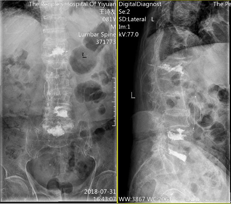 单切口双节段微创手术治疗老年人骨质疏松性脊柱骨折