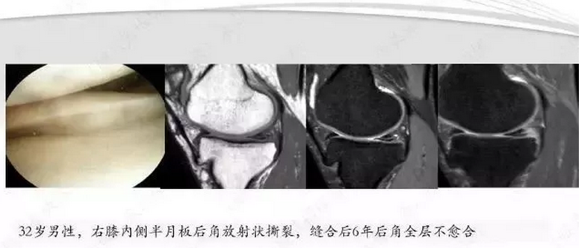 【半月板】半月板损伤的mri诊断