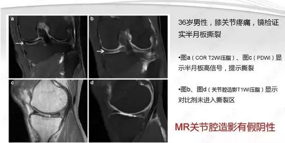 【半月板】半月板损伤的mri诊断