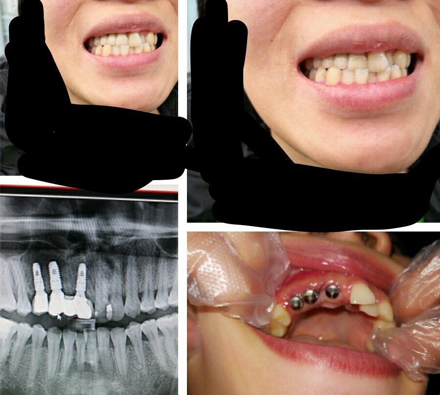 种植牙修复一例