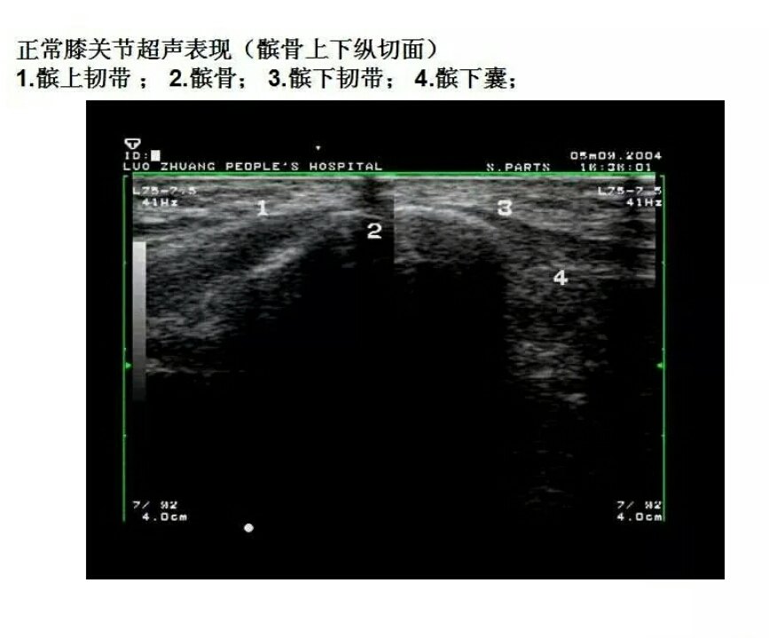 膝关节正常超声图解